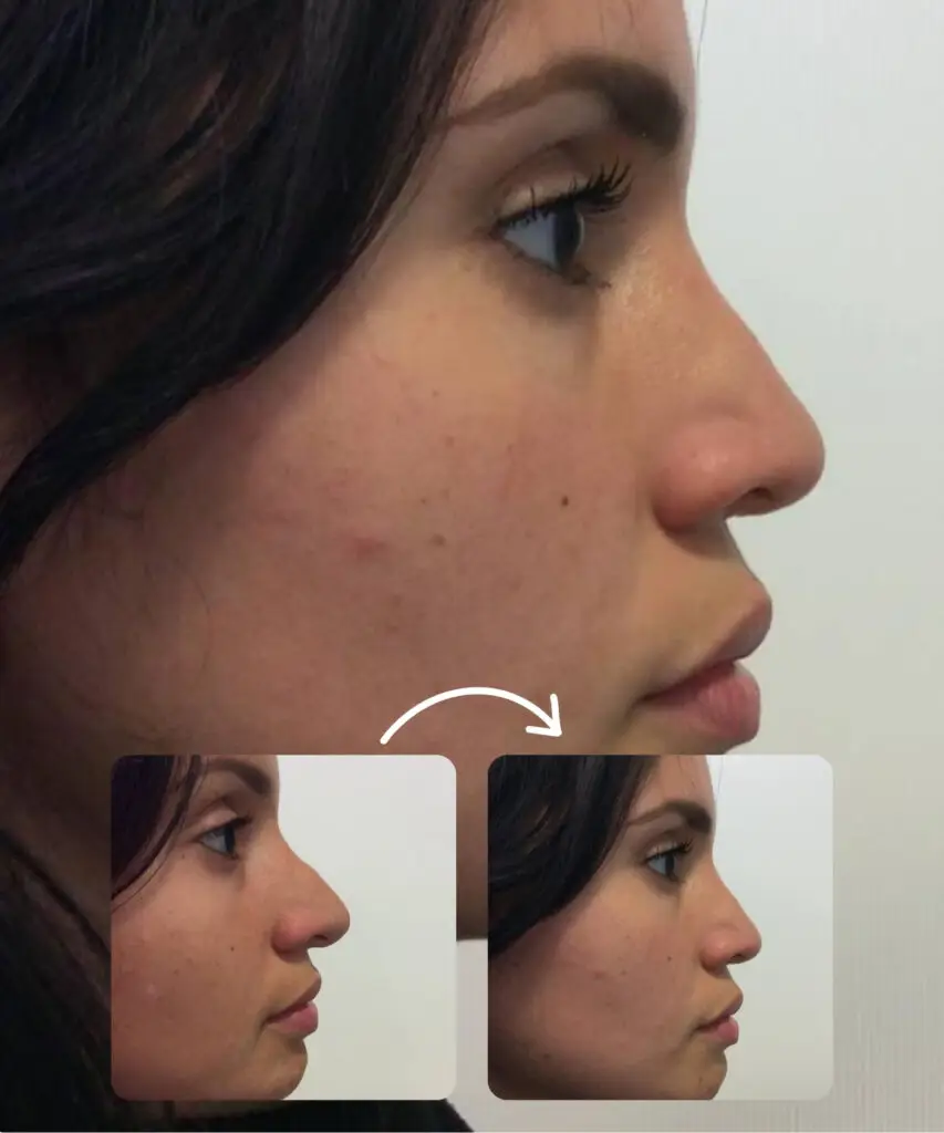 Burun Estetiği 1