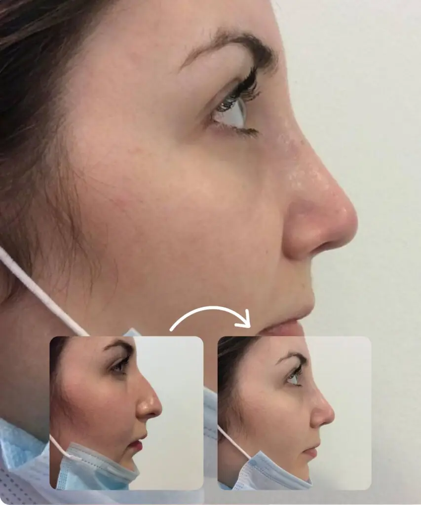 Burun Estetiği 3