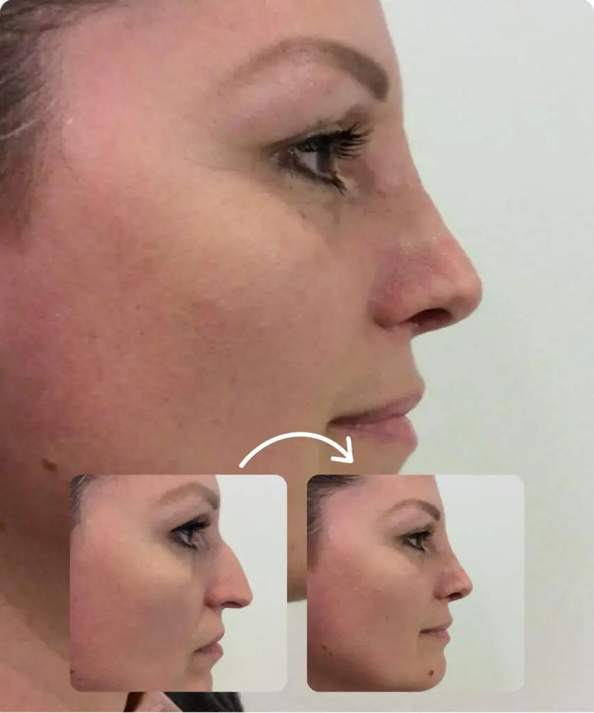 Burun Estetiği 4